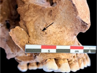 Scurvy in Medieval Barcelona Reveals the Hidden Toll of War and Food Shortages
