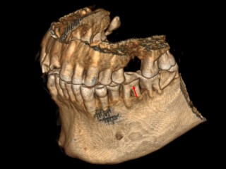 Forgotten Egyptian Mummy Head in Lithuania Reveals New Details of Ancient Embalming