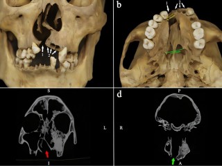 دفن من عهد أسرة تشينغ يكشف عن الرعاية والاندماج الاجتماعي لشاب مصاب بشق الشفة في الصين